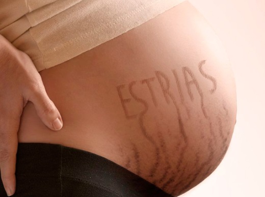38a48 como prevenir estrias depois da gravidez3