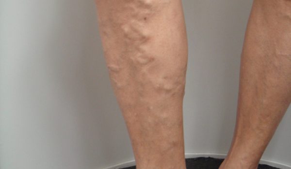 5aebe conheca o que e tromboflebite