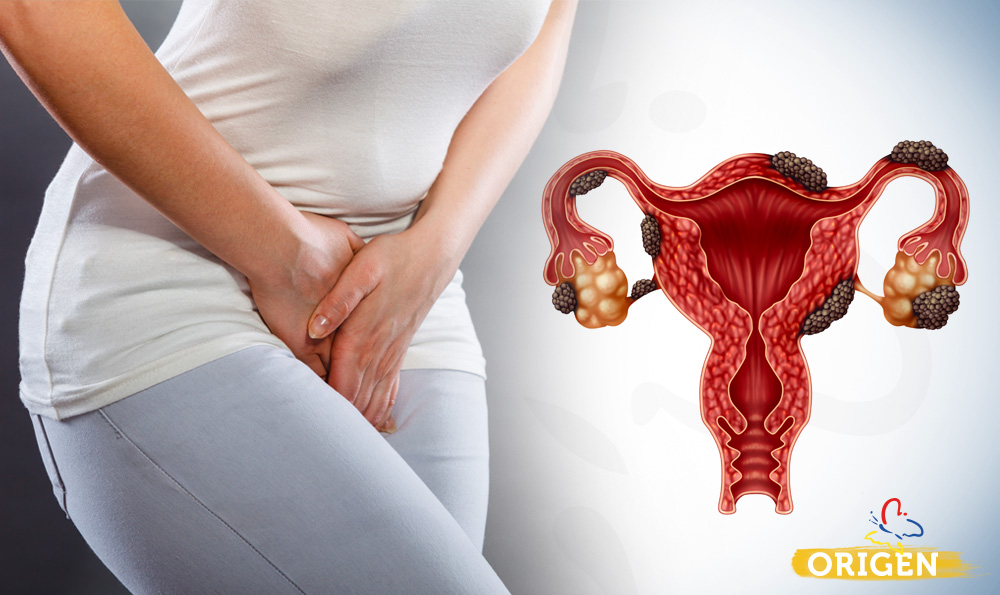 o que e endometriose