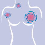 Onde o cancer de mama se espalha – Clinica Cleveland