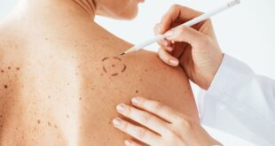 como prevenir cancer de pele