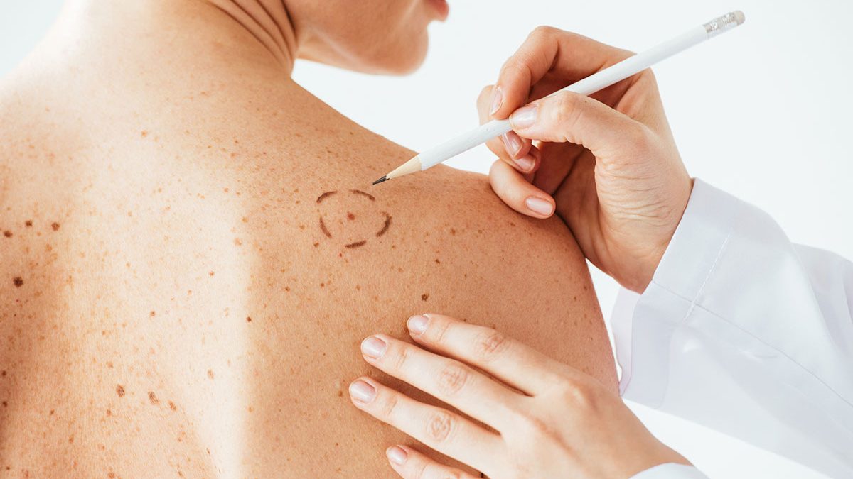 como prevenir cancer de pele