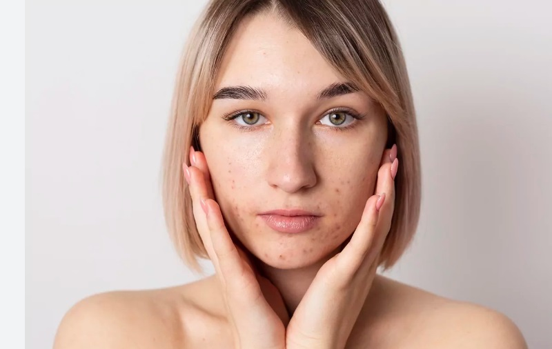 10 Dicas para Melhorar da Acne Hormonal