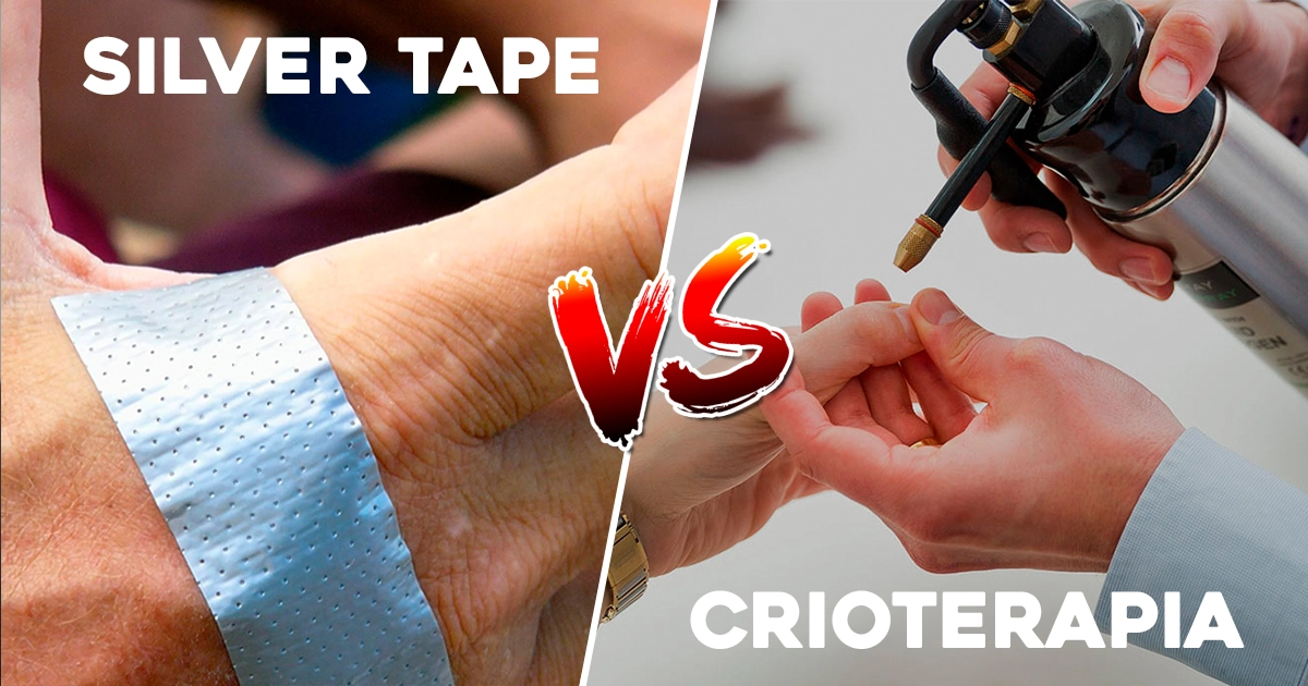 silver tape verruga crioterapi