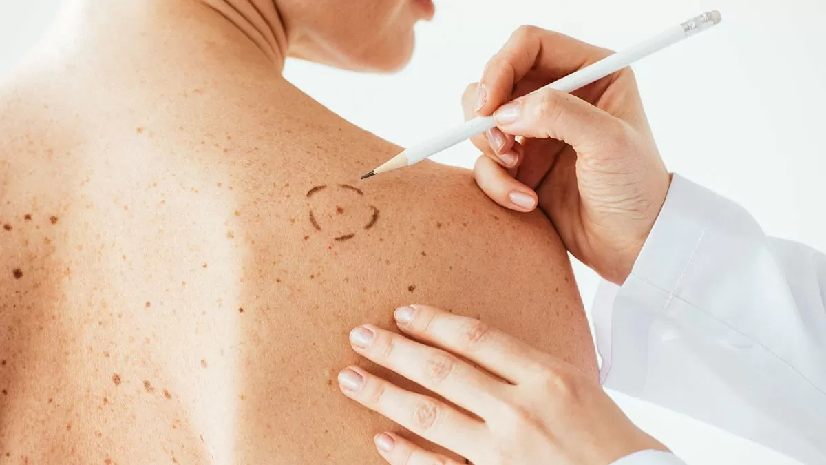 como prevenir cancer de pele